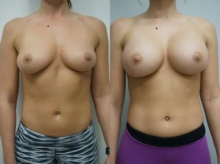 Breast Augmentation Before and After Pictures Case 129 Gilbe