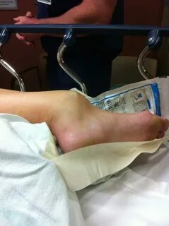My broken ankle. Roller derby. My fault. - Imgur