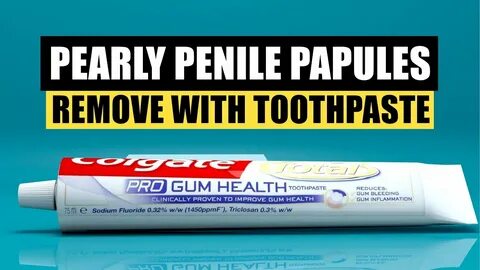How to Remove (PPP) Pearly Penile Papules using Fluoride Too