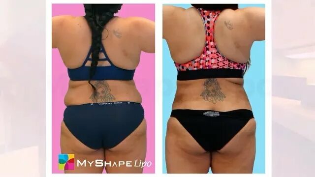 MyShape Lipo.