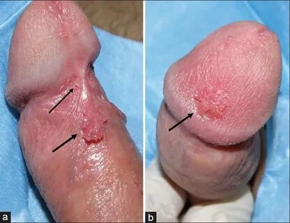 a) Multiple HPV lesions (penile warts) at the frenular area 