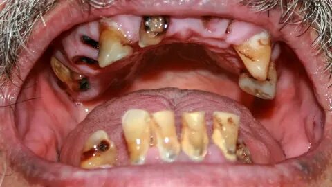 Pictures Of Kids With Rotten Teeth - De For School