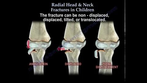 Radial Head & Neck Fractures In Children - Everything You Ne