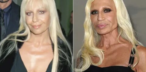 Donatella Versace Before Plastic Related Keywords & Suggesti