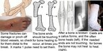 SAM Splint Techniques: How to Treat Broken Bones in Preppers
