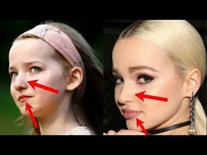 Dove Cameron Before Plastic Surgery - YouTube