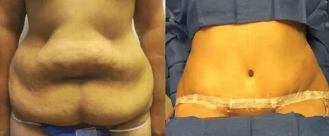 Tummy Tuck Before & After Pictures - California Surgical Ins