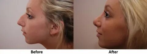 Chin Implant Before and After Spasurgica