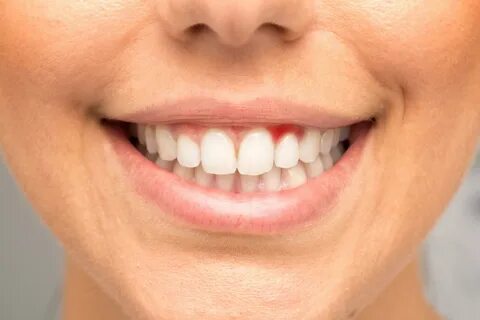 Симптомы зубов: как определить лезут ли зубы и что делать - 