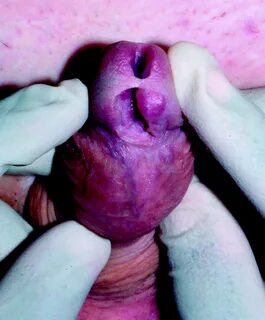 An unusual complication of penile piercing: a report and lit