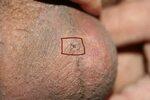 Pictures of normal post-vasectomy bruising after 6 days