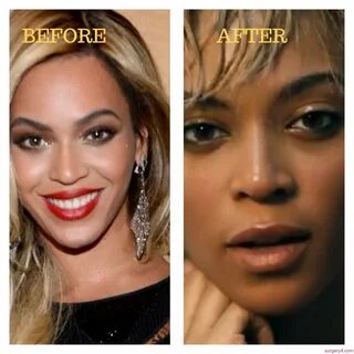 Beyonce Nose Job Photos Before & After - Surgery4