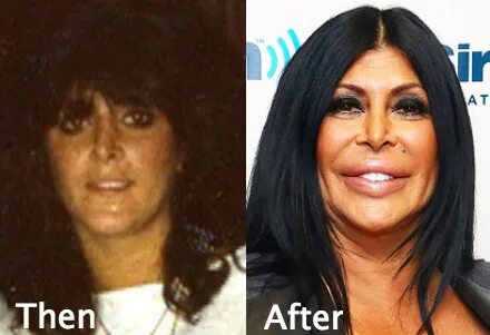 Big Ang Plastic Surgery Gone wrong - Latest Plastic Surgery 