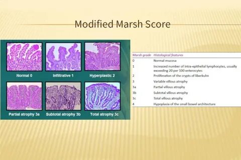 Celiac disease презентация, доклад