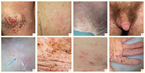 Take rapid action if scabies infestation is suspected in an 