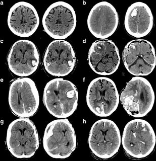 Computed tomography (CT) scans of eight different patients w