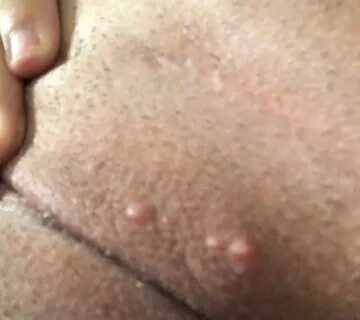 Ingrown hairs on boobs