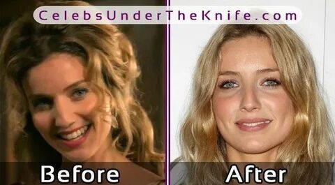 PEAKY BLINDERS - Annabelle Wallis Before After Plastic Surge