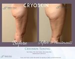cryoskin toning thighs before and after - About Face Anti-Ag