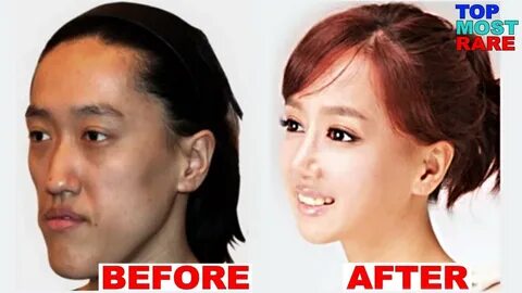 Filipino Plastic Surgery Before And After