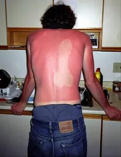 Funny sunburns Funny sunburn, Sunburn meme, Bad sunburn