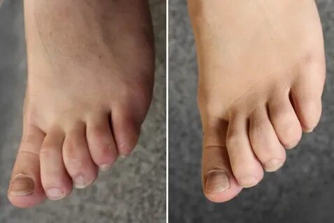 Ugly Feet? Try Concealer