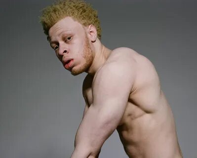 Nude Albino Girls Pics