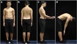 Non-structural misalignments of body posture in the sagittal