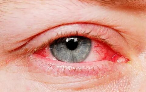 Флегмона глаза: симптомы, причины и особенности лечения