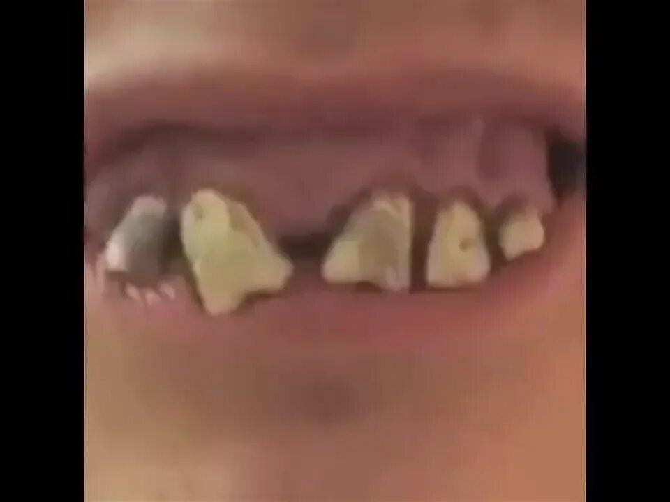 Hässlich Zähne - YouTube