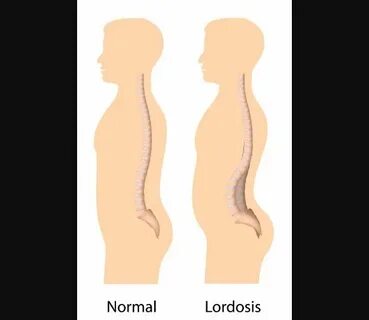 Lordosis - Penyebab - Gejala dan Pengobatan - IDN Medis