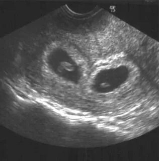 Transvaginal ultrasound demonstrating viability of twin preg