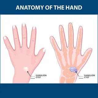 Ganglion Cysts Information Florida Orthopaedic Institute