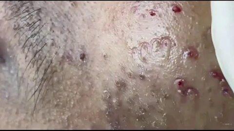 Acne Removal Treatment Super Satisfying Blackhead Removal - 