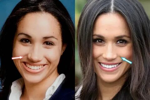 Meghan Markle Plastic Surgery - Nose Job, Teeth - before and