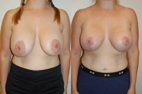 Breast Lift 