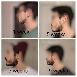 1 Year Patchy Beard Growth