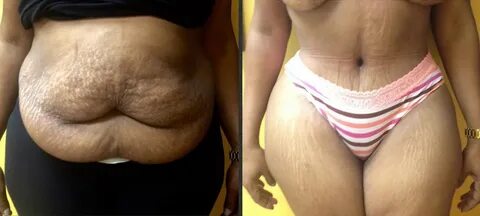 High BMI Tummy Tuck: How Safe is It? - PLUS SIZE HIGH BMI TU