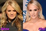 Carrie Underwood Before and After Cosmetic Surgery Laser hai