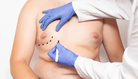 Liposuction on man boobs