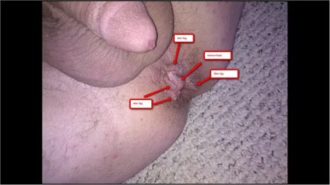 Anal skin tag photos 👉 👌 Official page selling.digitalmarketinginstitute.com