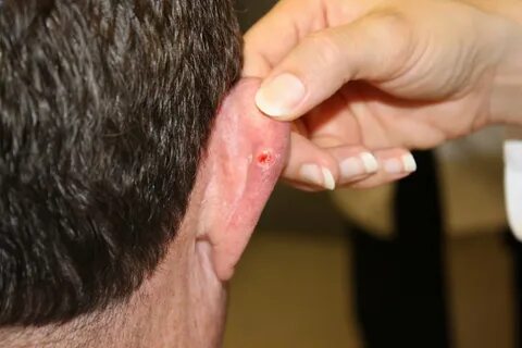Skin Cancer On Ear