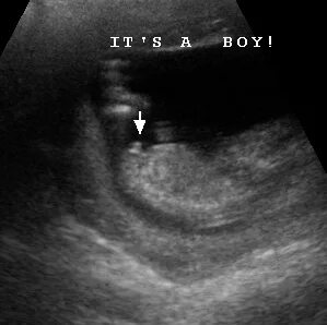 13 Week Ultrasound Gender Pictures - the meta pictures