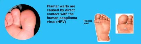 What Causes Plantar Warts? Understanding Why They Appear on 