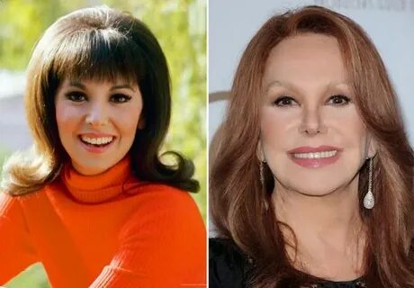 Marlo Thomas Plastic Surgery Nose Job Before and After Facel