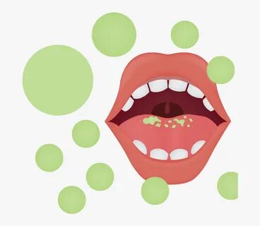 Graphic Of Mouth With Green Spots On Tongue And In - Bad Bre