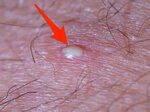 How To Remove An Ingrown Hair On Penile Shaft - Escons