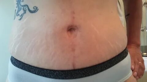 Adventures in Gastric Bypass Surgery: Stretch Marks and Bell