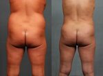 Brazil Butt Lift Nude