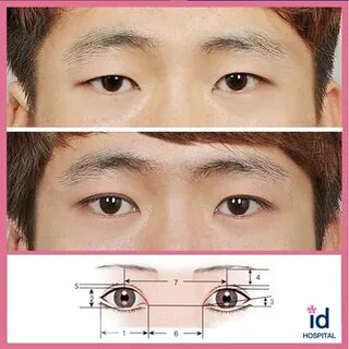 Men double eyelid surgery